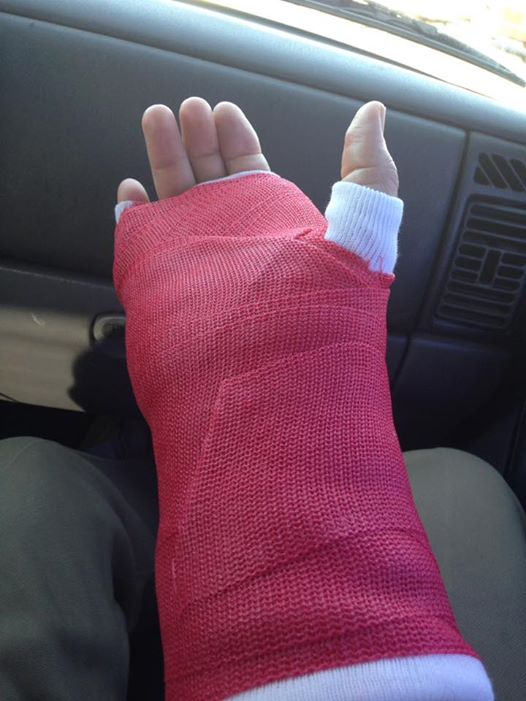 Broken Hand!